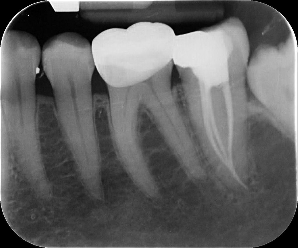 Endodonzia - Devitalizzazione - Studio Dentistico Dr. Stanislao Torquato